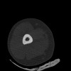 SPORK, NICO - 22.03.1976 - 02.08.2022 - CT obere Extremität - 17:51:17